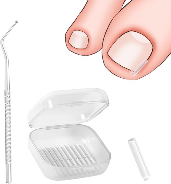 40 Pcs Ingrown Toenails Smoothing Strips - Toenail Lifter - Voor het Corrigeren van Ingegroefde Teennagels van Merkloos	