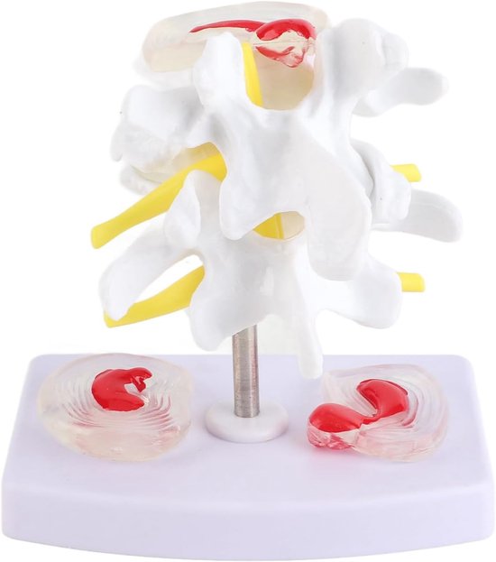 Lumbale Disc Hernia Demonstratie Model - Anatomische Human Spine - School Trainingsbenodigdheden voor Studenten - Leraren - Artsen van Merkloos	